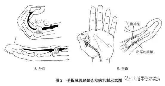 没有扣过扳机的你却得了“扳机指”？