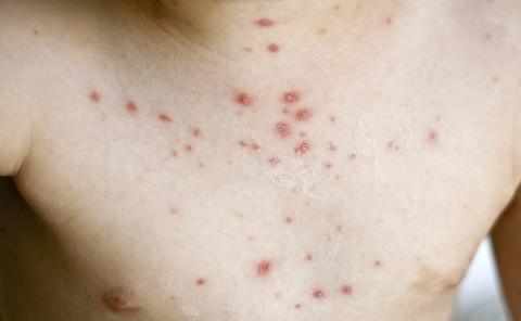 湿疹有什么草能治好,什么草治疗湿疹最有效