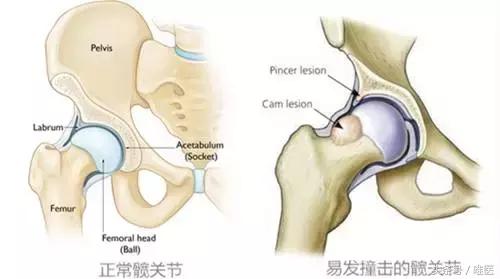 容易误诊成股骨头坏死的疾病,磁共振股骨头坏死有没有可能误诊