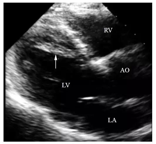 超声左心房强回声,二尖瓣腱索断裂超声有哪些表现