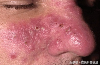 酒渣鼻玫瑰痤疮是怎么引起的,玫瑰痤疮会变成酒渣鼻吗