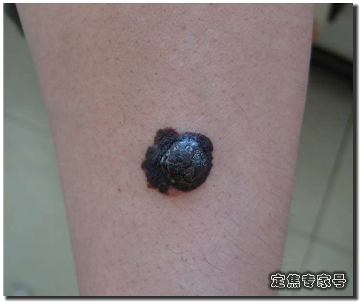 手指长黑痣需要割吗,高中生指甲上有白点怎么治