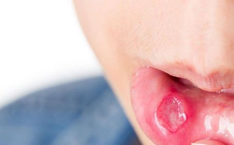 口腔溃疡不一定是上火碰上口腔溃疡，不知道喝再多凉茶也无补