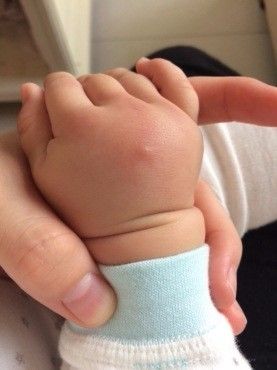 孩子手上扎了刺不弄出来有事吗,手上扎刺去医院处理需要多少钱