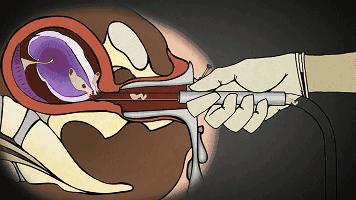 妇产科医生说反复人流的女人可加速衰老,看你还动不动就去人流不