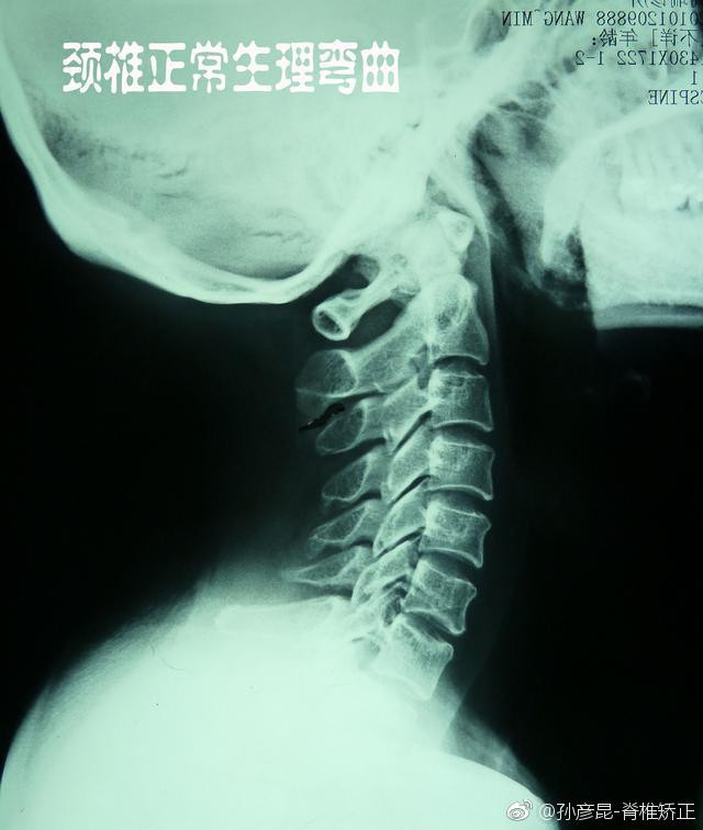 重庆治疗颈椎病最好的医院,治疗颈椎病的锻炼方法视频