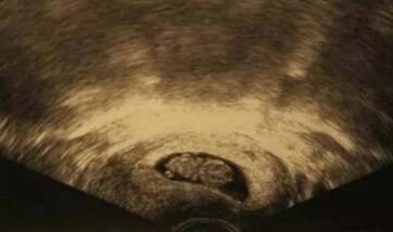 阴式超声检查会导致流产吗,刚怀孕做超声对宝宝有影响吗