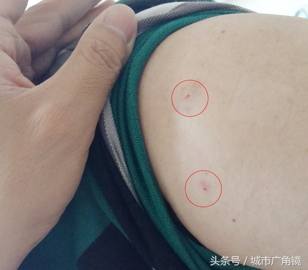 强力治疗肩周炎的特效药,治肩周炎一针见效