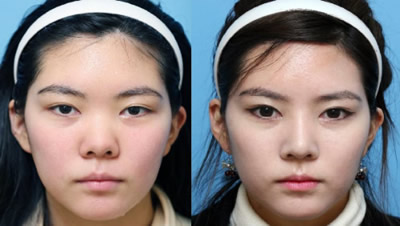 隆鼻手术后多长时间鼻头完全消肿,隆鼻手术失败了鼻头塌了怎么办