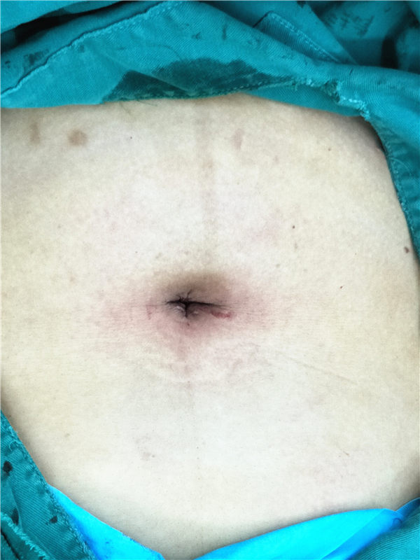 淄博妇幼宫腹腔镜,淄博市妇幼保健院腹腔镜手术