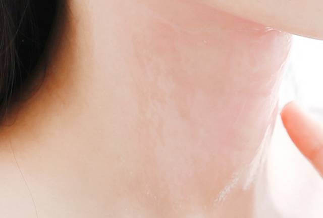 一条颈纹老十岁教你一招淡化,年纪小就有一条很深的颈纹