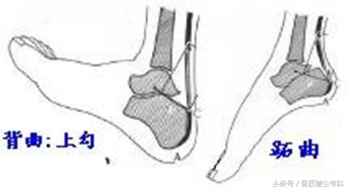 脚跟骨质增生,最全解析(含锻炼方法和防、治)