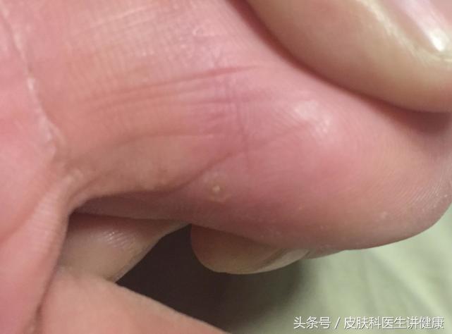 脚上起疱疹不痒但是痛,脚上长水泡要弄破吗