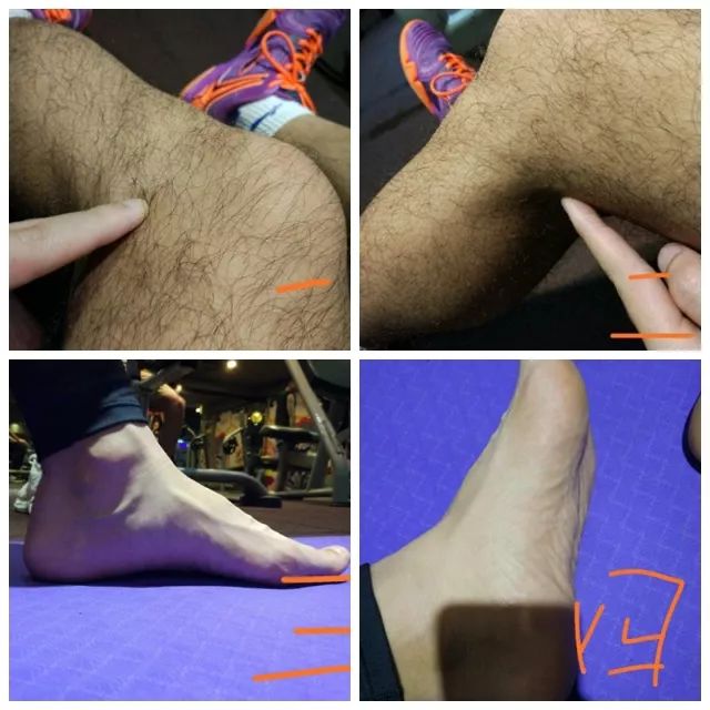 髌腱支持带在哪个位置,髌腱炎和髌腱末端病的区别