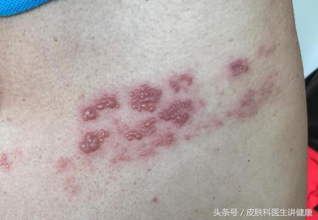 脖子带状疱疹大面积水泡,脖子起疙瘩是带状疱疹吗