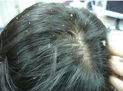 头皮屑最好最快解决方法,头皮屑满天飞了怎么办