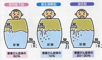 吃出来的痛风能治愈吗,什么东西吃后痛风