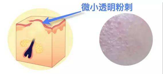 长了闭口粉刺之后怎么办