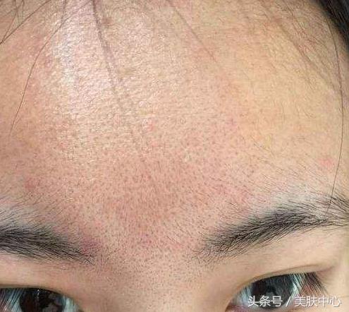 脸上油脂太多老是堵塞毛孔怎么办,油脂分泌过多毛孔堵塞导致长疙瘩