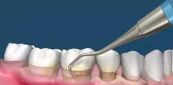 有颗牙齿很臭,拔掉的牙齿很臭