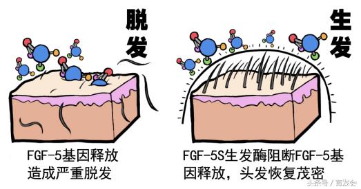 章光101脂溢性脱发效果怎么样,脂溢性脱发中医能治愈多久有效果