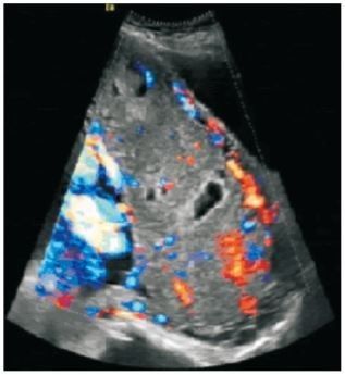 凶险性前置胎盘出血4次,边缘性前置胎盘大出血保胎成功率