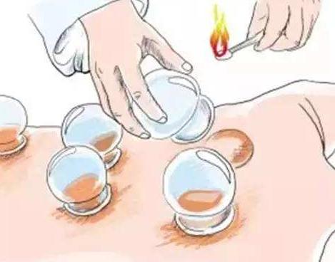 哮喘爹爹拔完火罐后右肺“消失”了