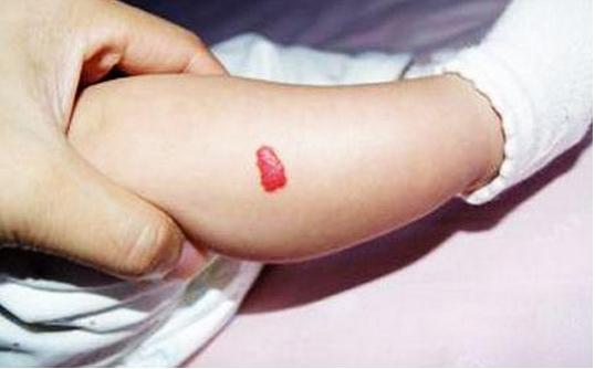 1岁宝宝腿上长一片斑,1岁宝宝腿上出小红点