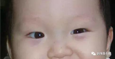 黄帝内经眼袋描述,黄帝内经如何治疗眼袋下垂