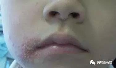 黄帝内经眼袋描述,黄帝内经如何治疗眼袋下垂