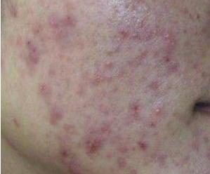 皮肤粘胶带过敏用什么方法不过敏,皮肤红痒过敏好了过几天后过敏