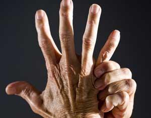 手指关节肿胀发热疼痛是怎么回事,早上醒手指关节肿胀疼痛怎么回事