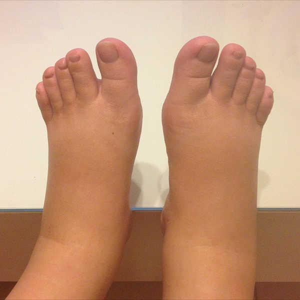 怀孕晚期有尿感就宫缩,孕晚期尿频宫缩严重是要生了吗