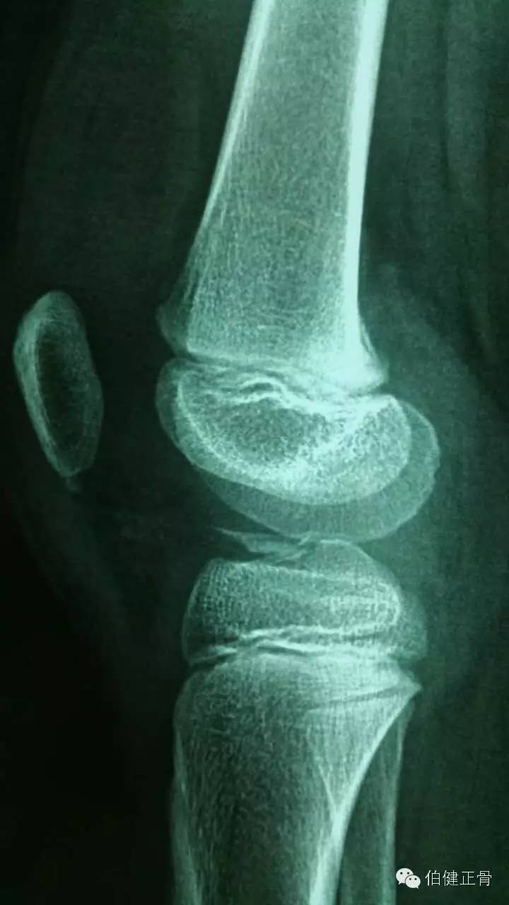关节内外、经骨骺/不经骨骺单隧道纽扣技术治疗小儿前交叉韧带止点撕脱骨折经验介绍