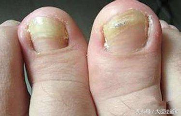 健康的脚什么形状,健康脚的重要性你知道吗