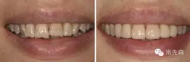 一周快速脸部美白小妙招,美容冠的形态怎么做的