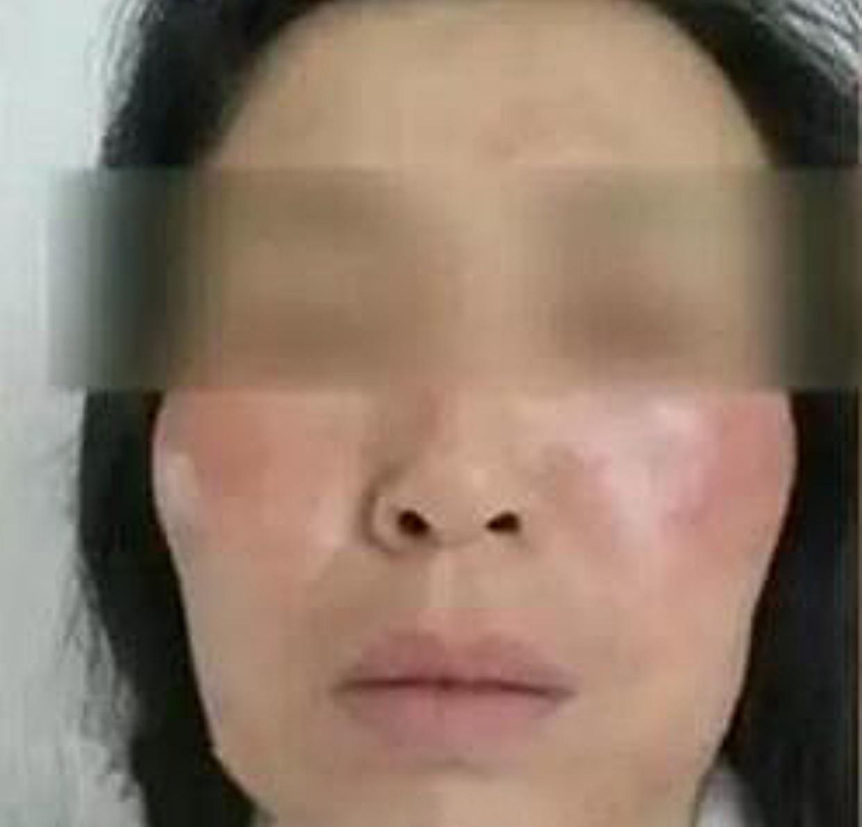 线雕的十大骗局,揭秘线雕埋线你不知道的内幕