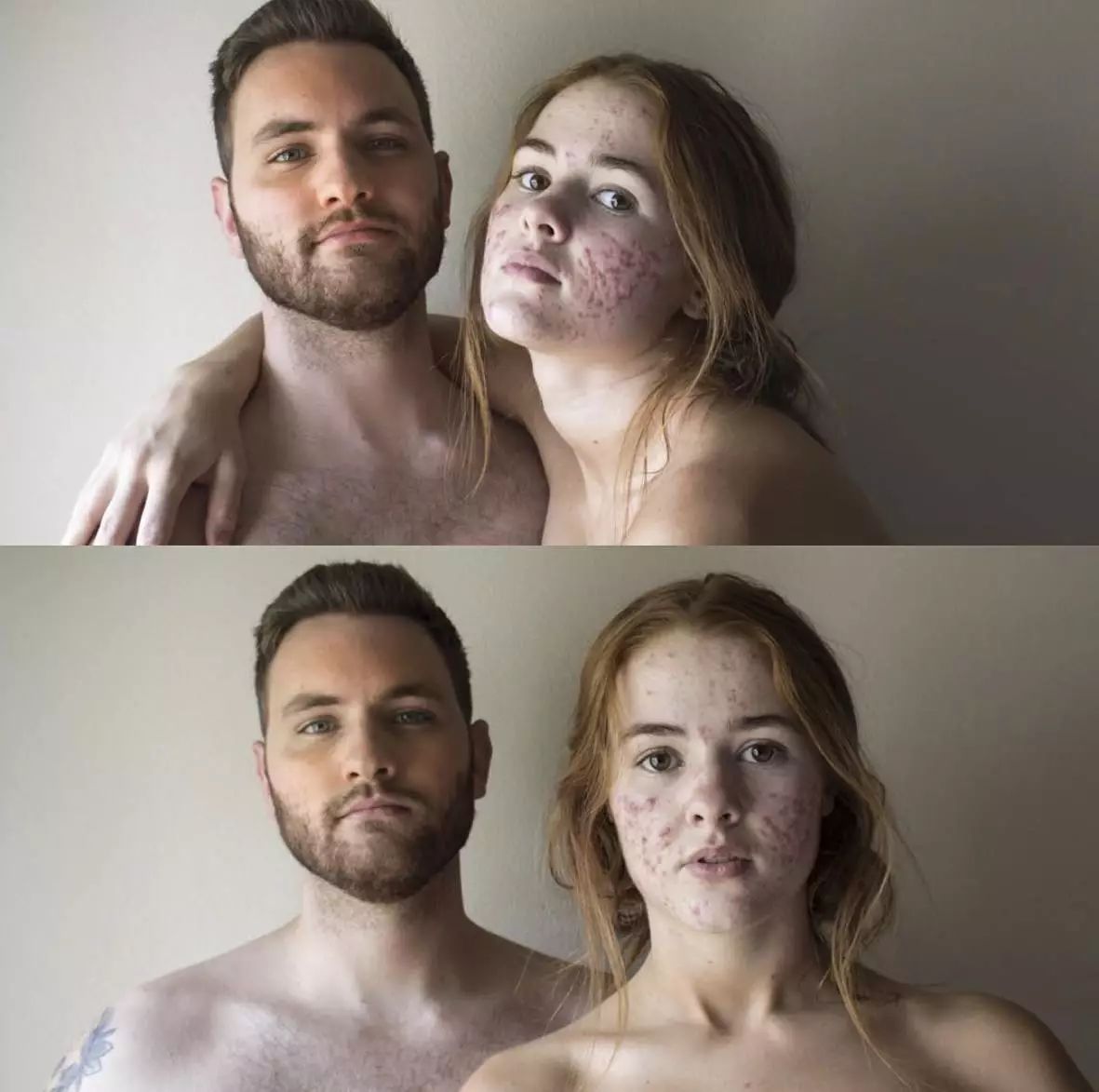 360°真实记录从满脸痘到痊愈，她红遍了Ins