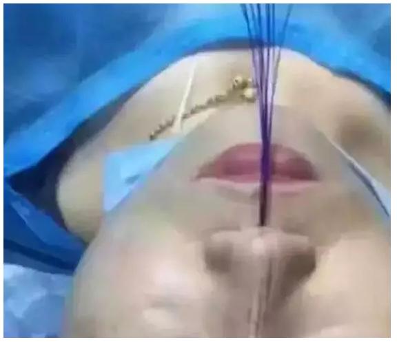 线雕的十大骗局,揭秘线雕埋线你不知道的内幕