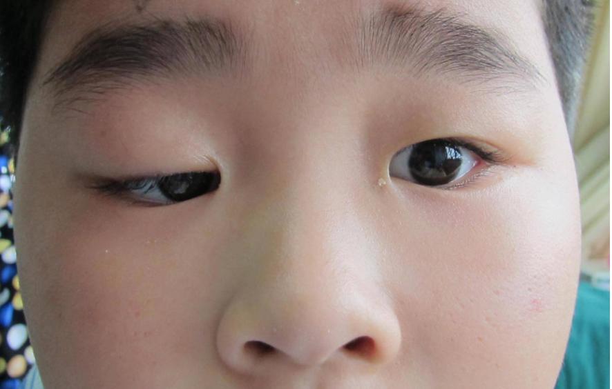 家长警惕：孩子一只眼大、一只眼小，可能是摊上了一种病