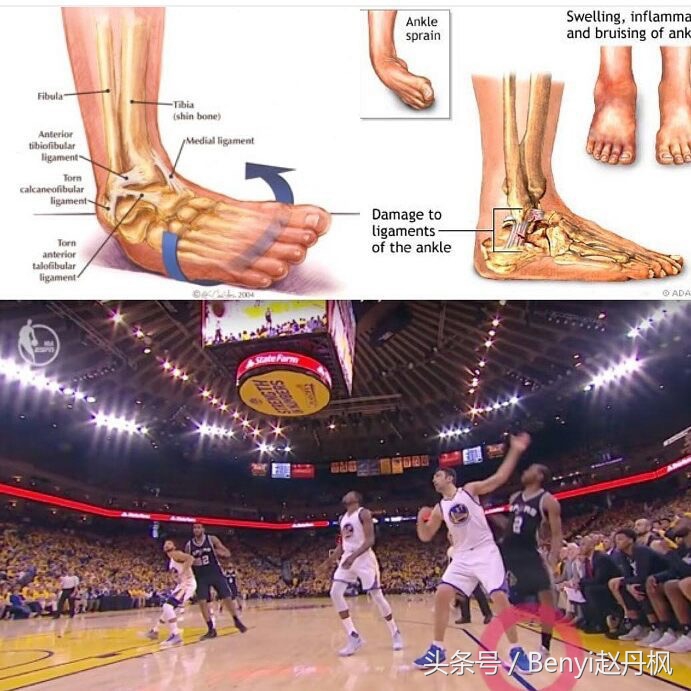 脚踝受伤半年后如何康复训练,脚踝伤病的六个问题