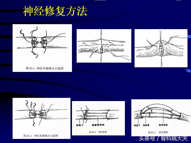 手肌腱损伤图片,手外伤神经肌腱损伤怎么定残