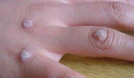 洗澡洗一身瘊子,后背长瘊子和搓澡有关系吗