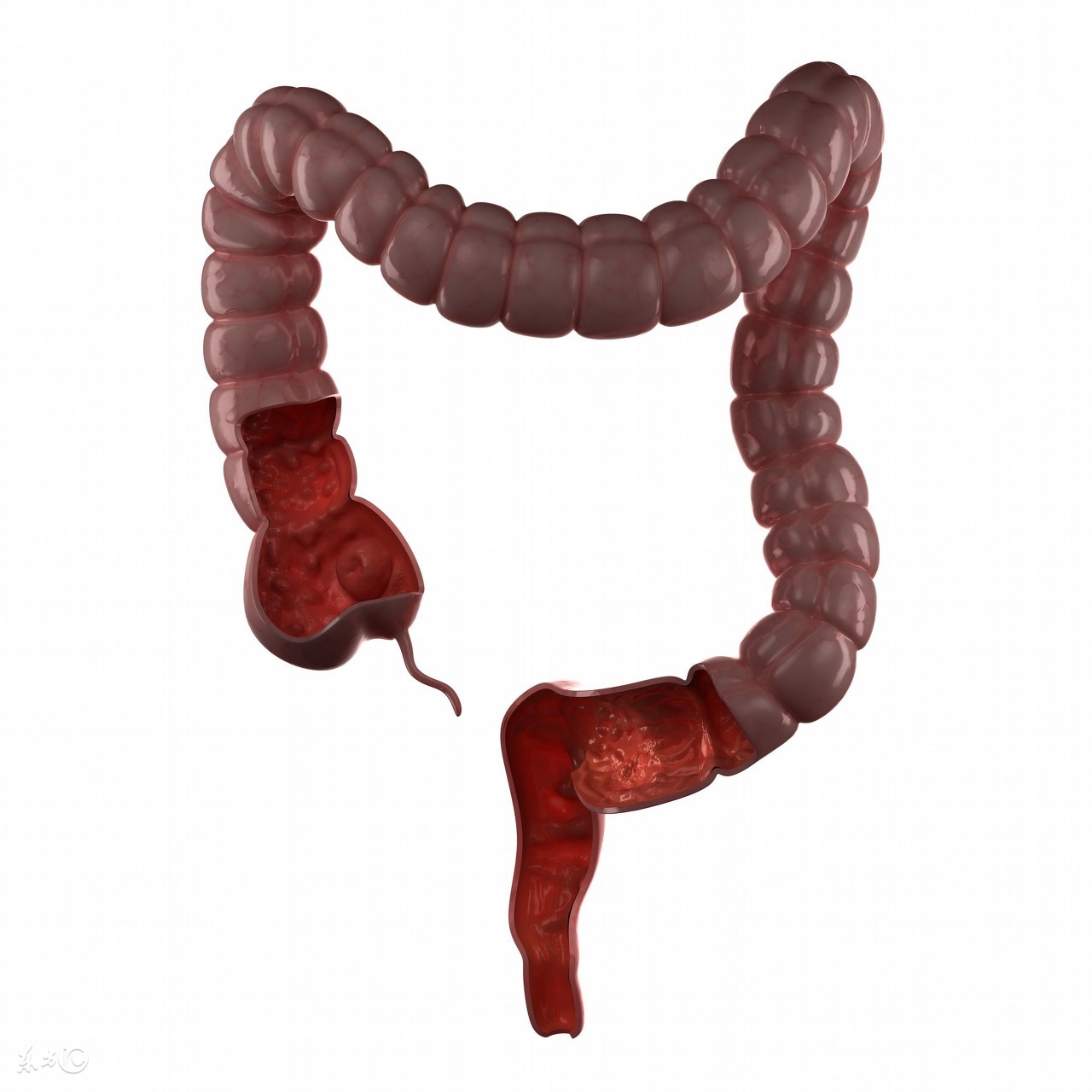 肛肠疾病是由什么原因引起的,肛肠问题的原因