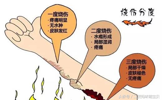 小孩子烫伤了怎么安慰她妈妈,孩子烫伤了怎么处理好得快