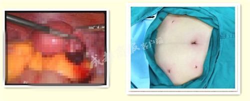 女人意外怀孕人流,女人意外做人流手术