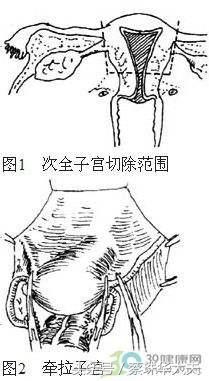 子宫次全切后会得宫颈癌,子宫次全切术后会出血吗