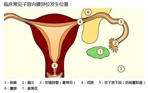 治疗子宫腺肌病的药物,专家讲解子宫腺肌症