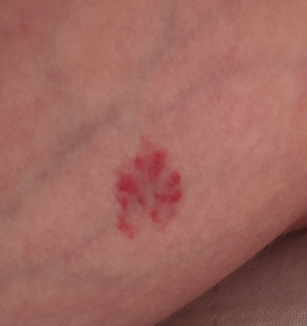 宝宝草莓状血管瘤不可怕，早发现，早治疗，附贴药操作视频