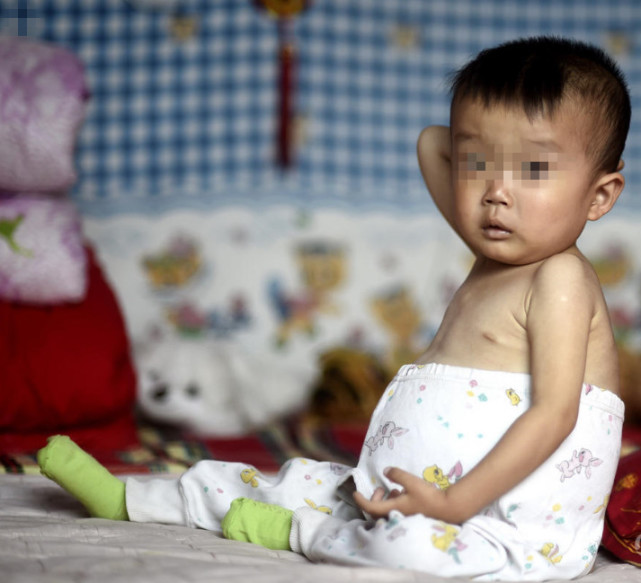 揪心,4岁孩子得怪病肚子不断胀大,妈妈爸爸为儿子别的都不顾了